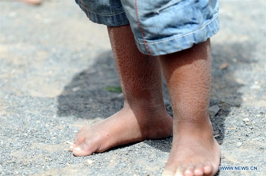 YEMEN-SANAA-DISPLACED PEOPLE