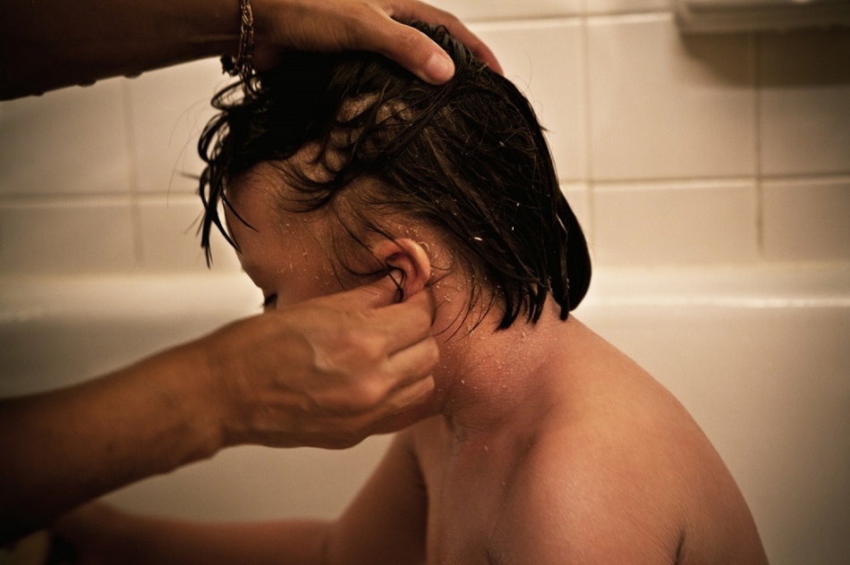 孤兒?。呼~鱗病女孩的艱難生活【圖】