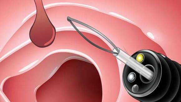 【健康解碼&middot;小貼士】檢查出息肉 需要切除嗎？