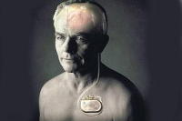 【健康解碼】起搏器真的能治好帕金森病嗎？